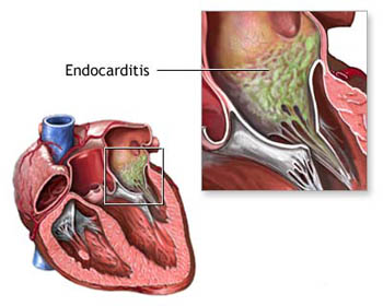 Resultado de imagen para Endocarditis