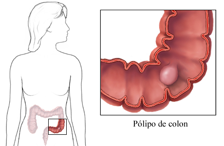 20100706 mgb Pólipo de colon .jpg