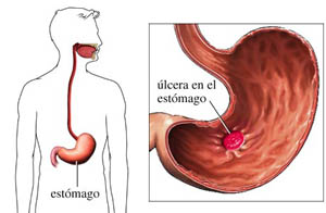 images of acute necrotising ulcerative gingivitis