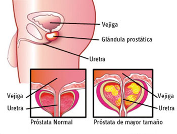 20090115 mgb Prostatitis .jpg