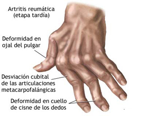 20080117 mgb Artritis .jpg