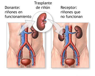 20100614 mgb Trasplante de riñón .jpg