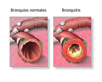 20080709 mgb Bronquitis .jpg