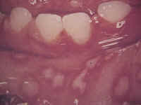 20090707 mgb Estomatitis herpética .jpg