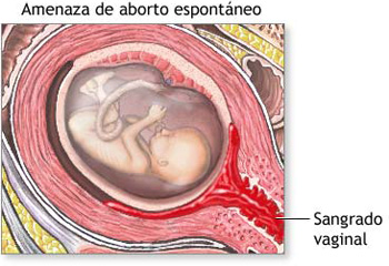 20080328 mgb Aborto natural .jpg