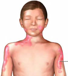 20080122 mgb Dermatitis .jpg