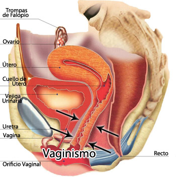 20140501 mgb Vaginismo .jpg