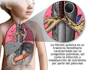 20080812 mgb Fibrosis quística .jpg