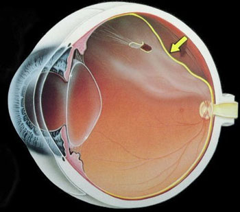 20090217 mgb Desprendimiento de retina .jpg