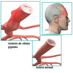 20071112 mgb arteritis .jpg