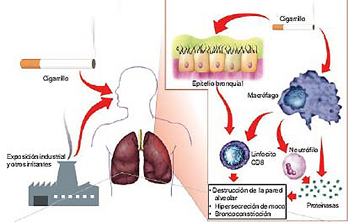 20100521 mgb Enfermedad pulmonar .jpg