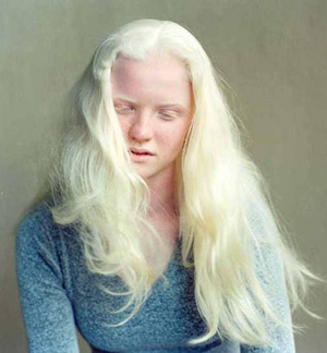 20101029 mgb Albinismo .jpg