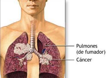 20100514 mgb Cáncer de pulmón .jpg
