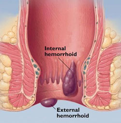 20071128 mgb hemorroides .jpg