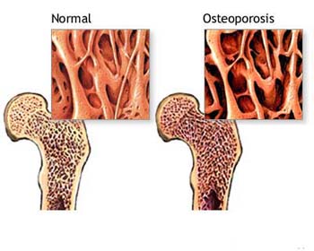 20080523 mgb osteoporosis .jpg
