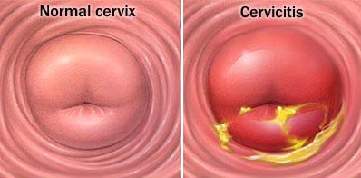 20100323 pbv cervicitis1 .jpg